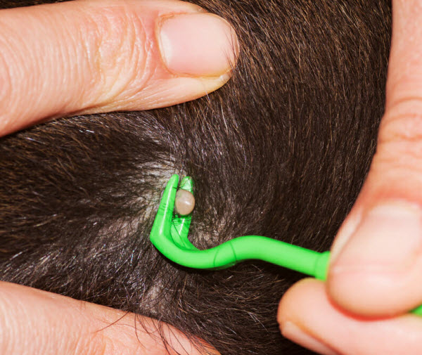 A close-up of a tick attached to a pet’s skin while being removed with a green tick removal tool.